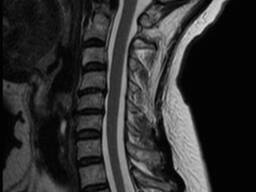 МРТ шийного відділу хребта: точна діагностика без болю в RADI